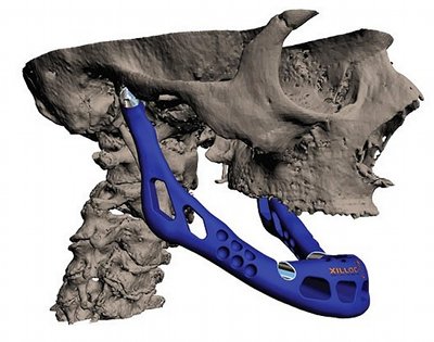 3D print jaw image